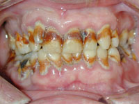 Tobacco Teeth
