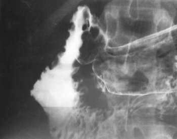 Pancreatic Rest Eus