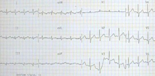 V Tach Ecg